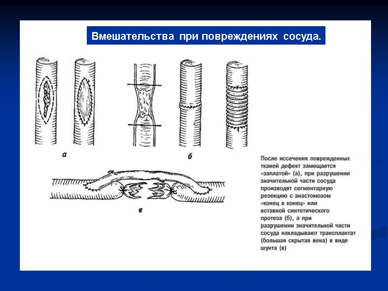 Вмешательства при повреждениях сосуда.